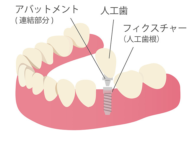 インプラント02