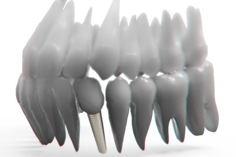 インプラント治療