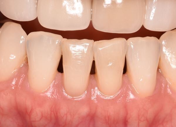 治療例_キャプチャ07