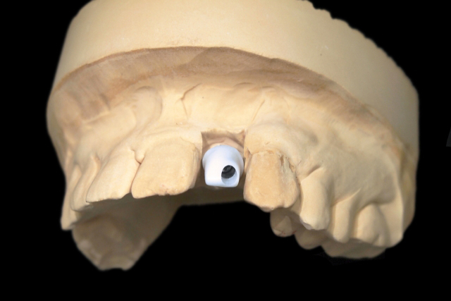 診療内容_インプラント