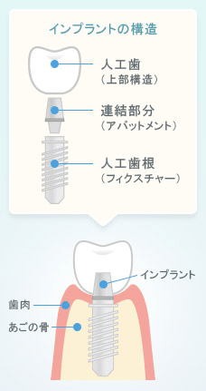 インプラントの構造について