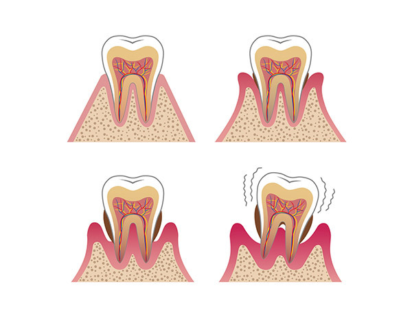 歯周治療