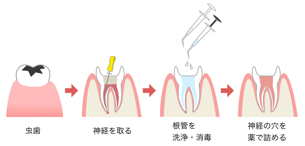 根管治療01