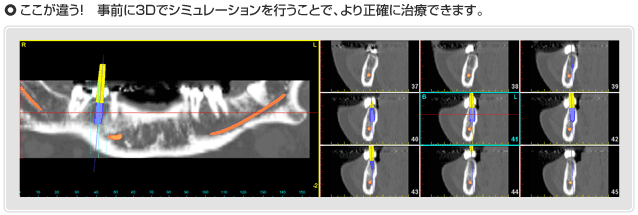 シンプラント