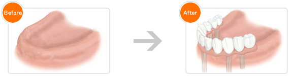 歯をすべて失った場合