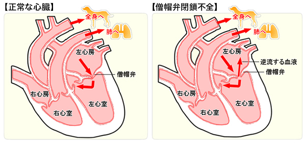 僧帽弁閉鎖不全の図