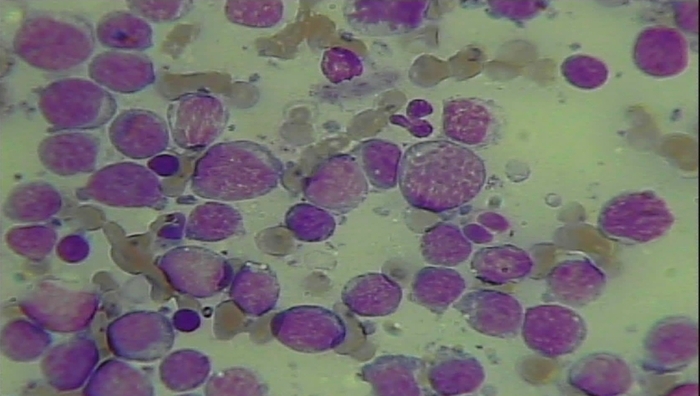 細胞診検査 リンパ腫