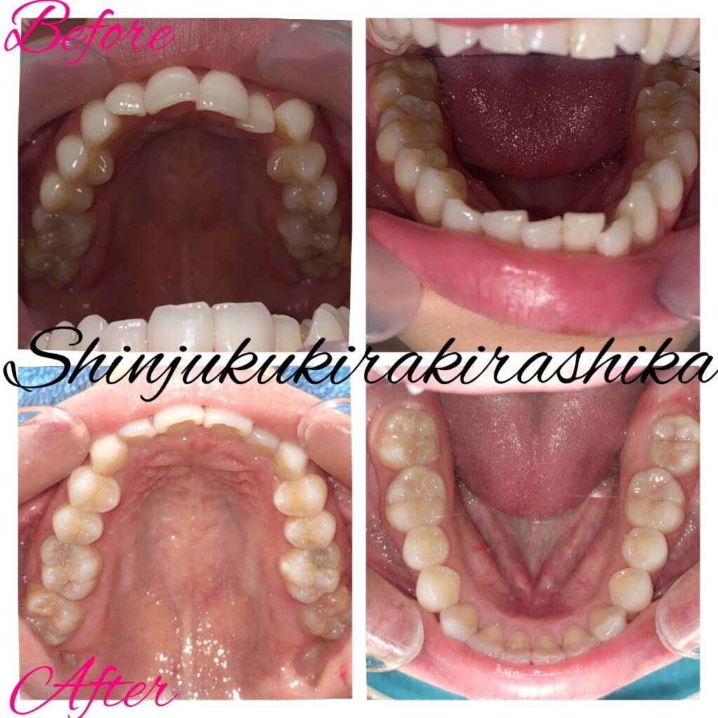 インビザラインgo05