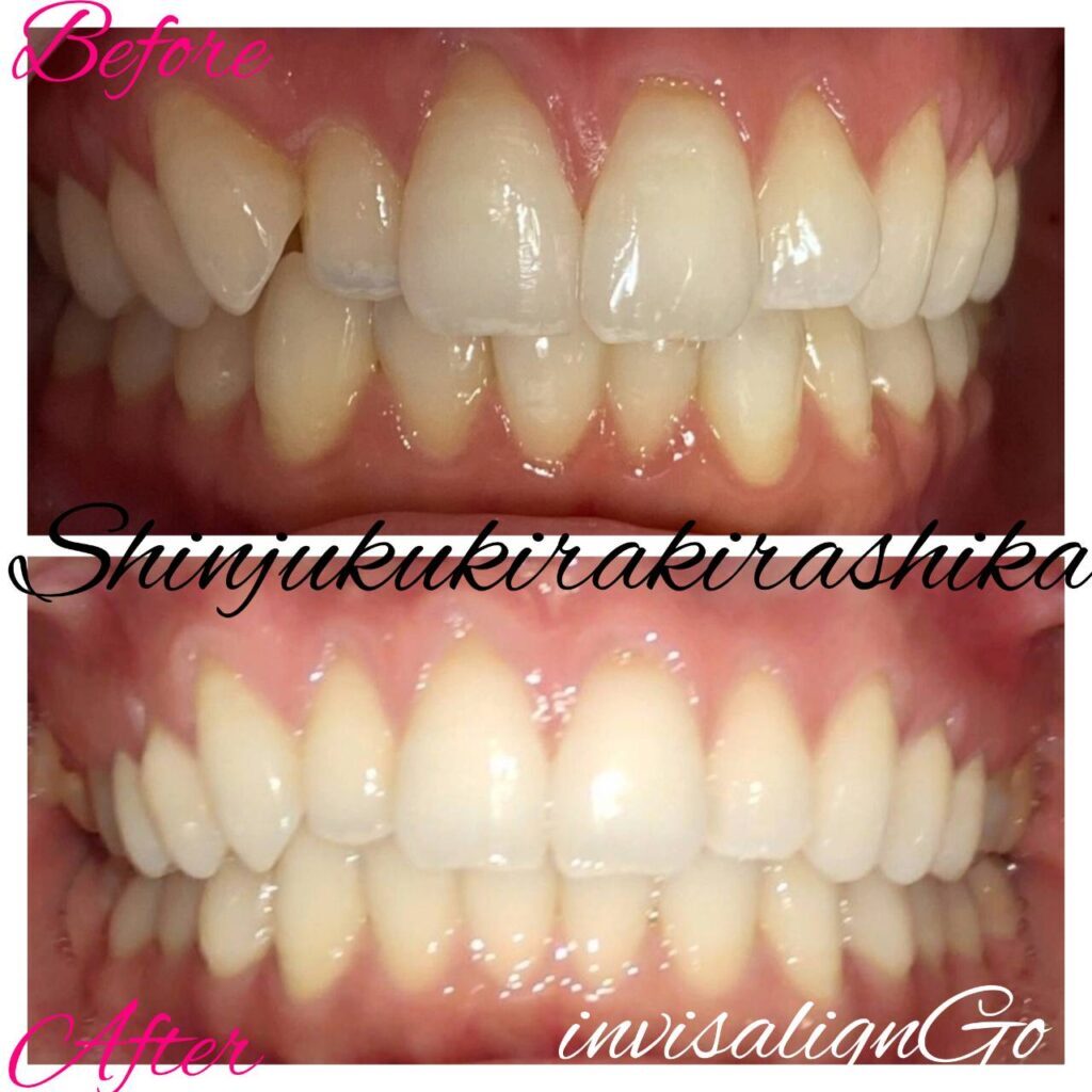 インビザラインgo04