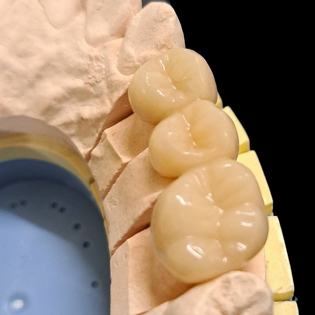 高強度硬質レジンブリッジ