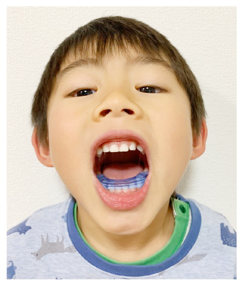 Vキッズのメリット