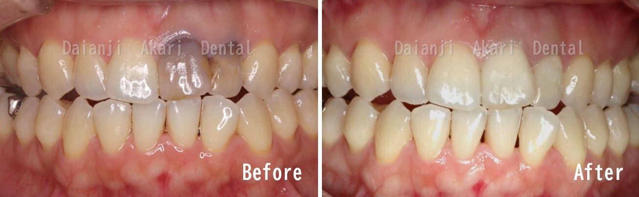 ブリーチング治療