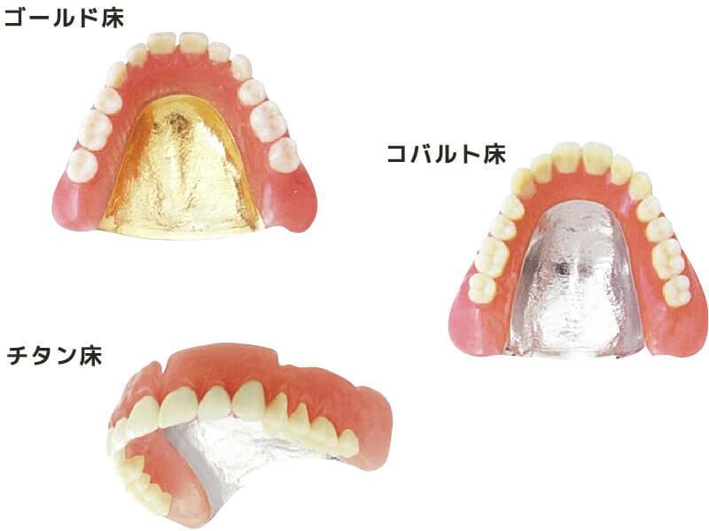入れ歯_金属床