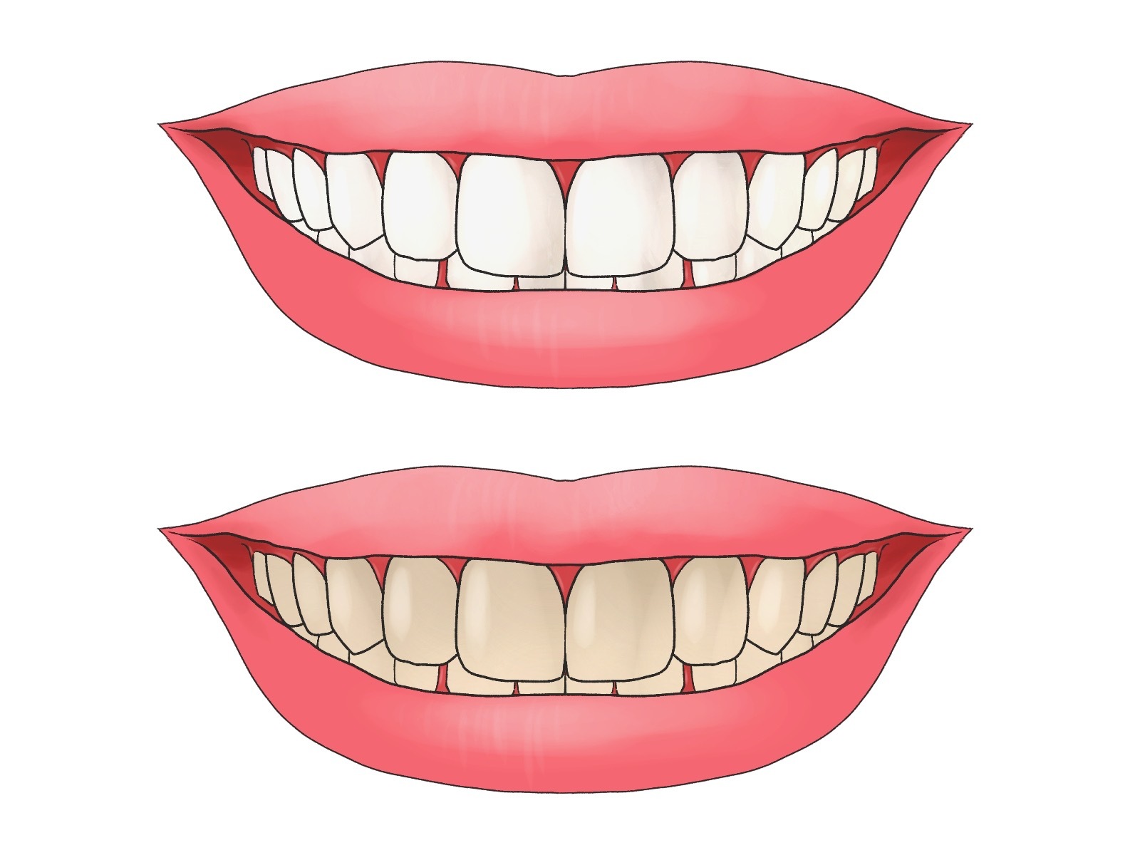 歯が着色する仕組みと原因②