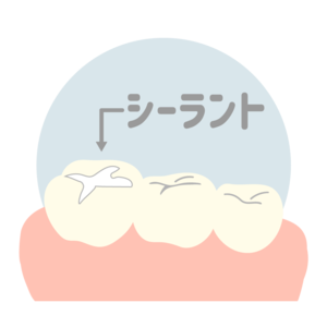 シーラント