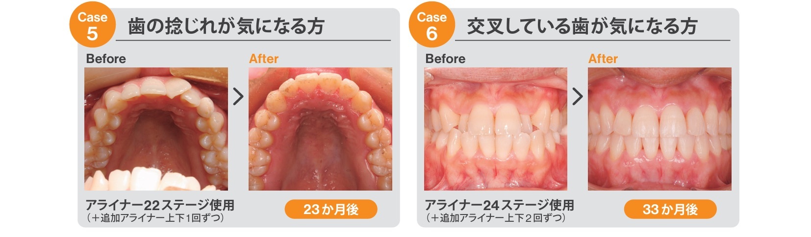 23.トリミング済み_Invisalign_カウンセリングツール_院内用_ページ_2-3