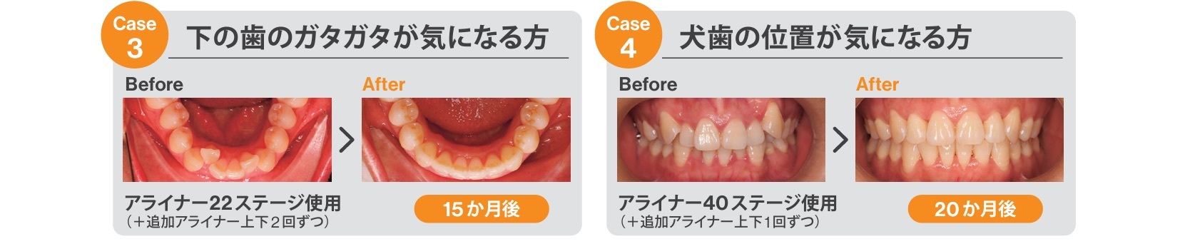 23.トリミング済み_Invisalign_カウンセリングツール_院内用_ページ_2-2
