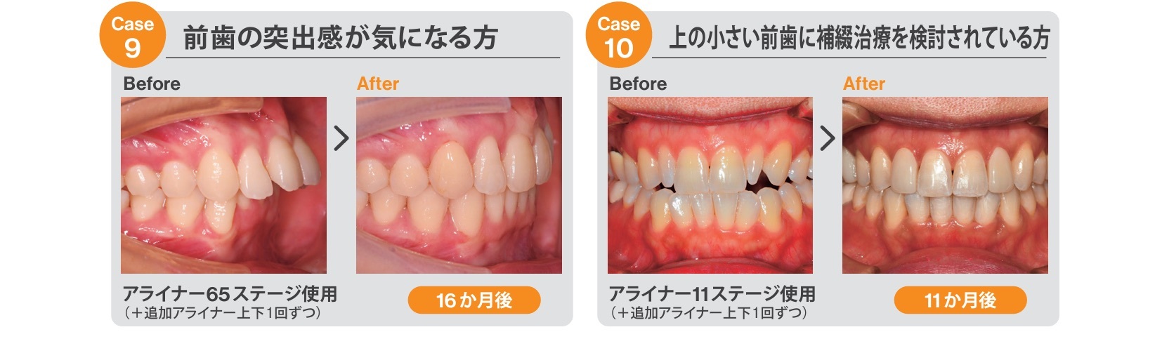 23.トリミング済み_Invisalign_カウンセリングツール_院内用_ページ_2-5