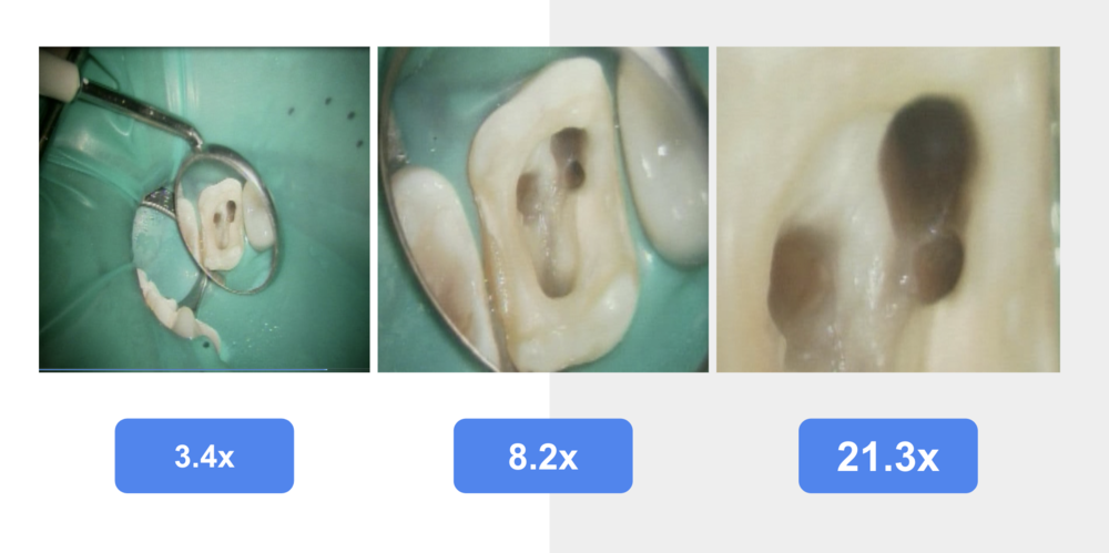 東白楽ハシビロ歯科 マイクロスコープ 根管治療