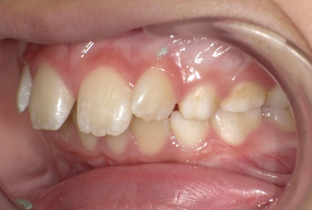 deep bite-deep overbite