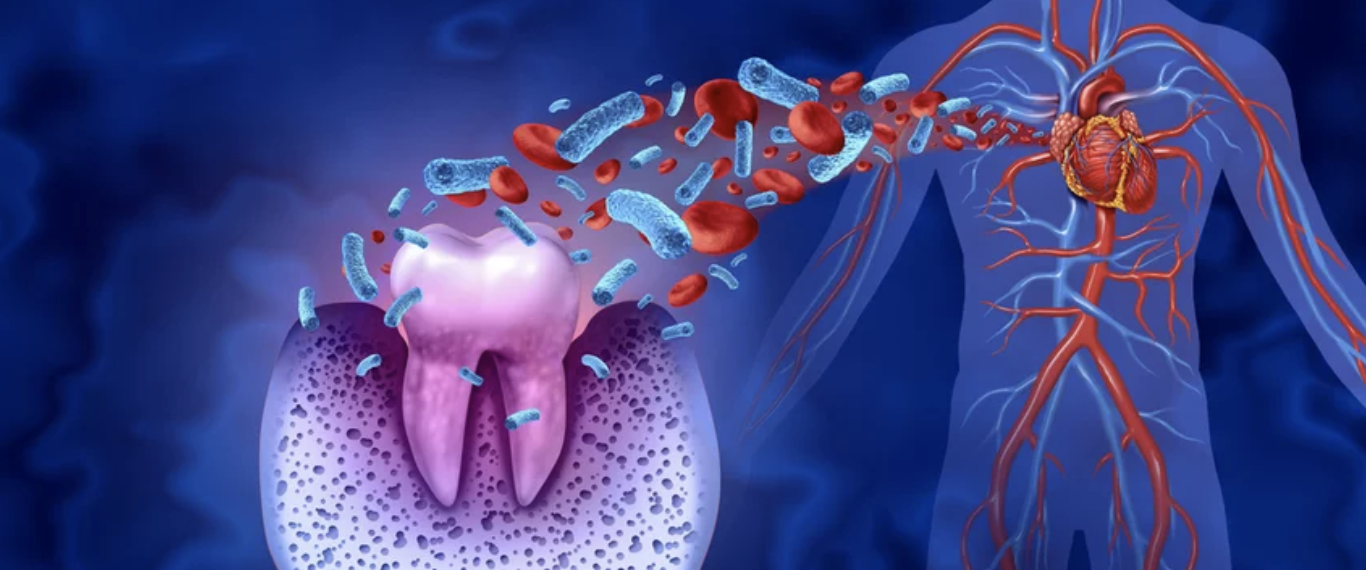 periodontal disease