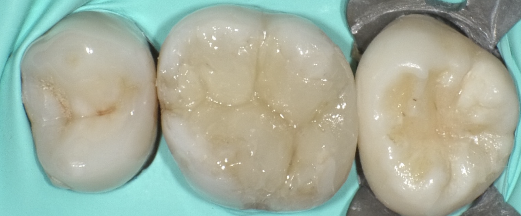 direct bonding-ceramic restoration_コピー