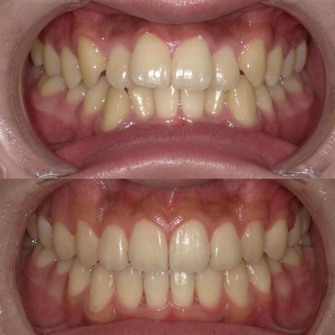 ortho before after