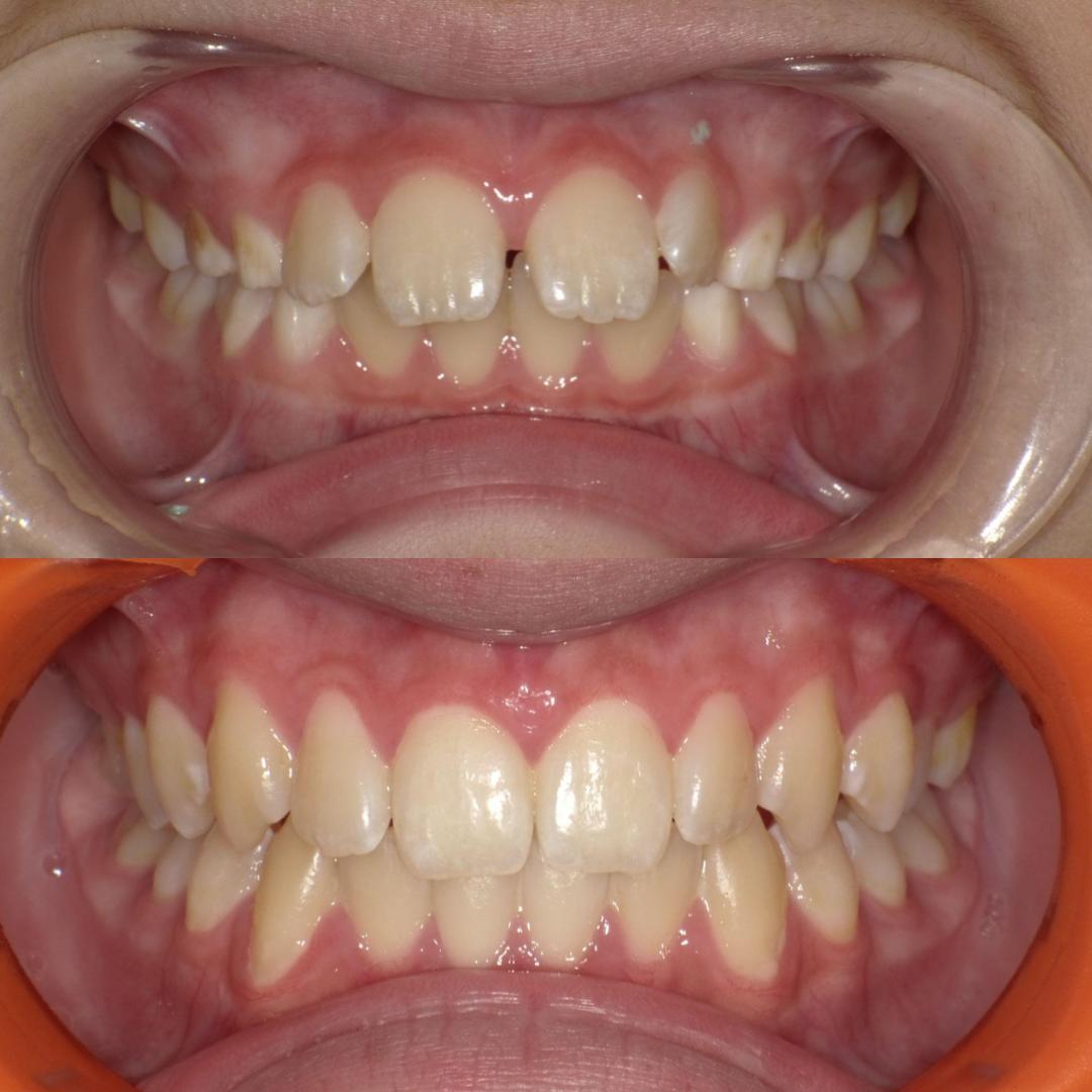 ortho before after deep bite