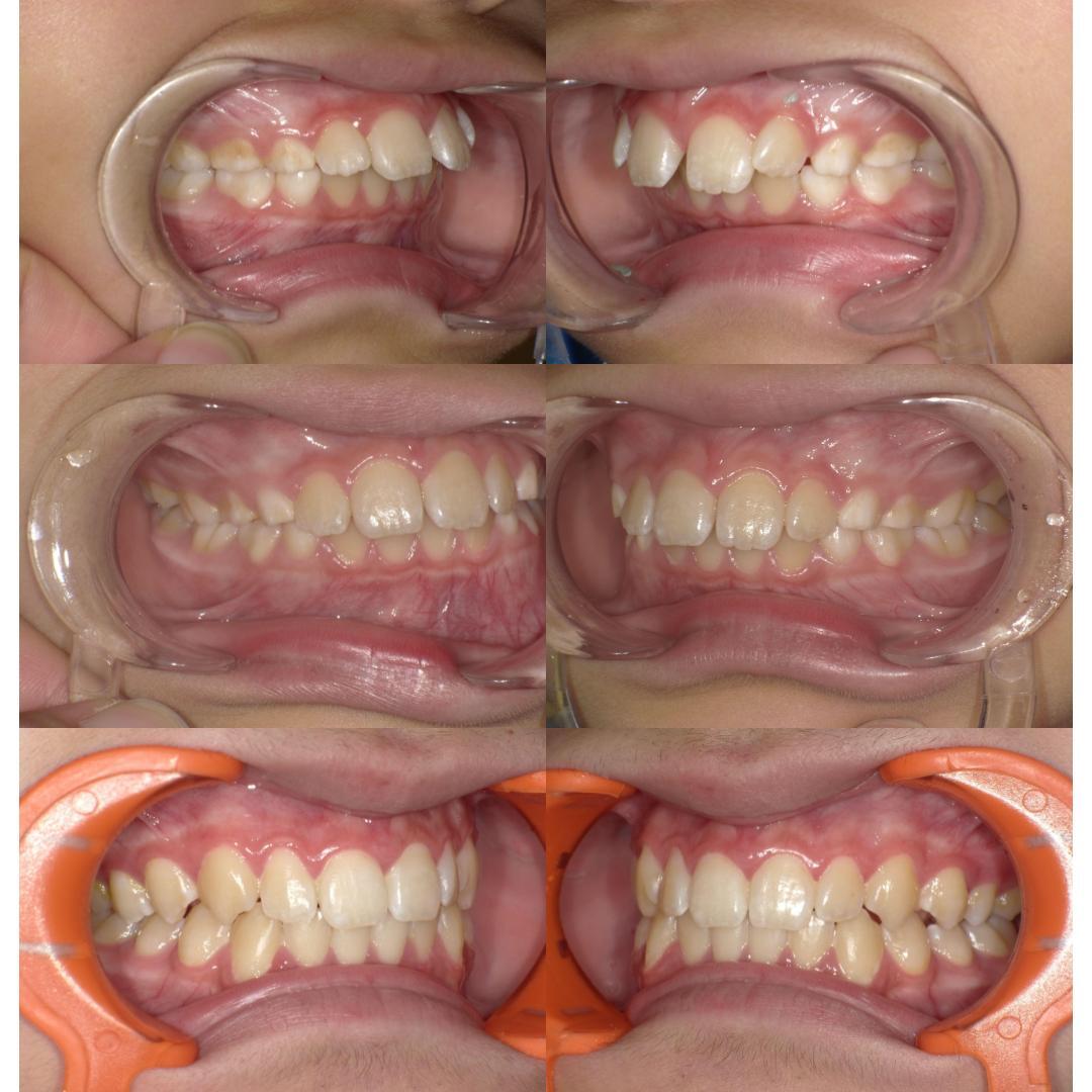 ortho before after deep bite