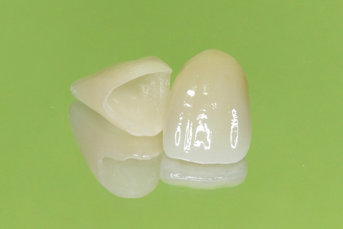 オールセラミッククラウン4