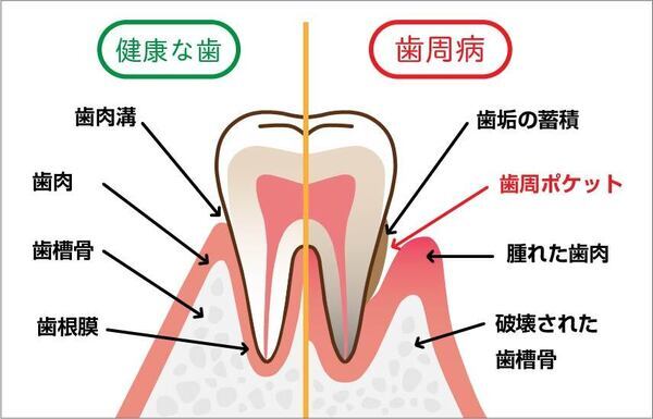 歯周炎_コピー