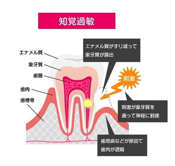 知覚過敏_コピー