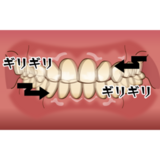 歯ぎしり