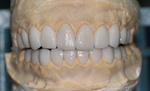 zirconia_841883451