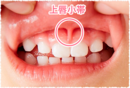 上唇小帯2
