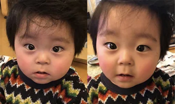 子供のはりきゅう治療