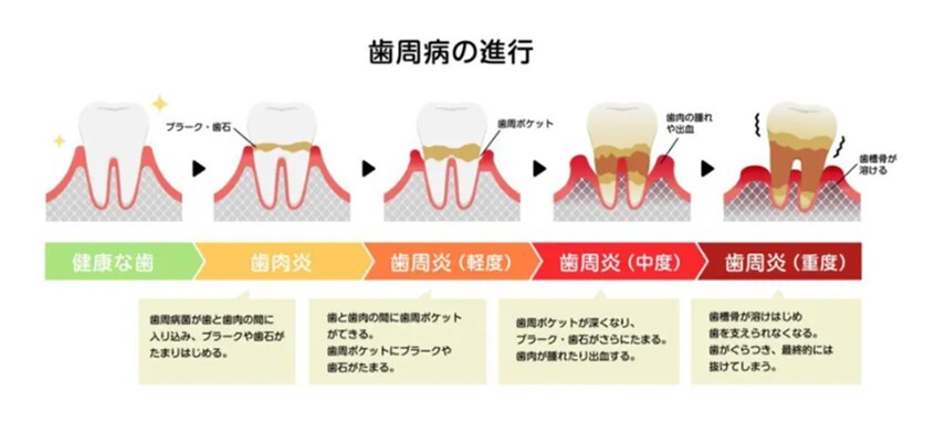 歯周病 進行