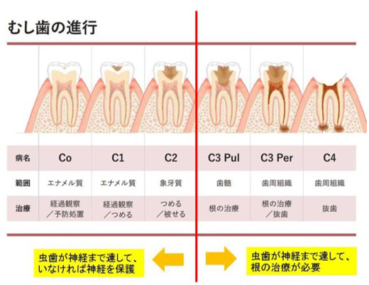 むし歯 進行