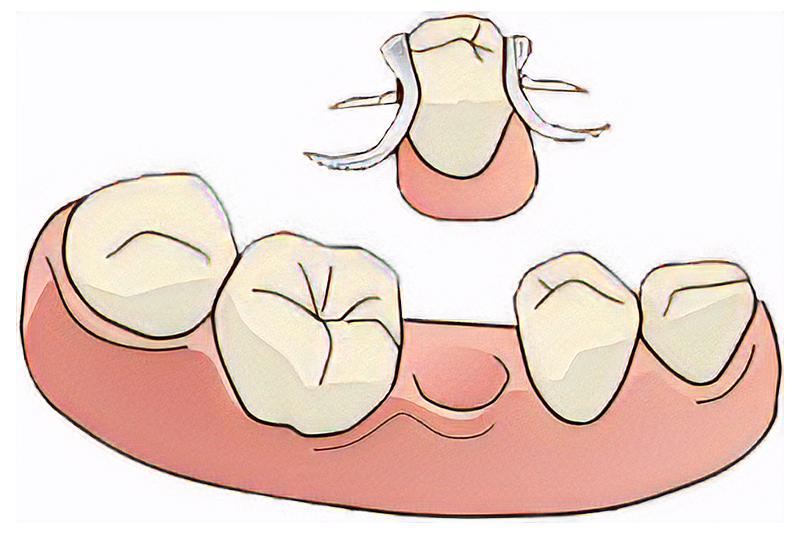 img_dentures04