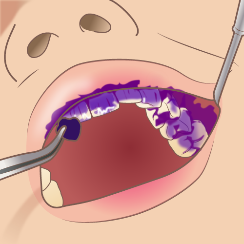 dental_disclosing_solution_2
