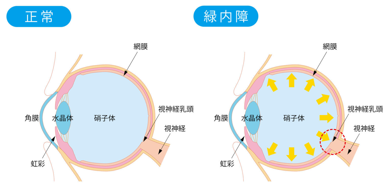 緑内障