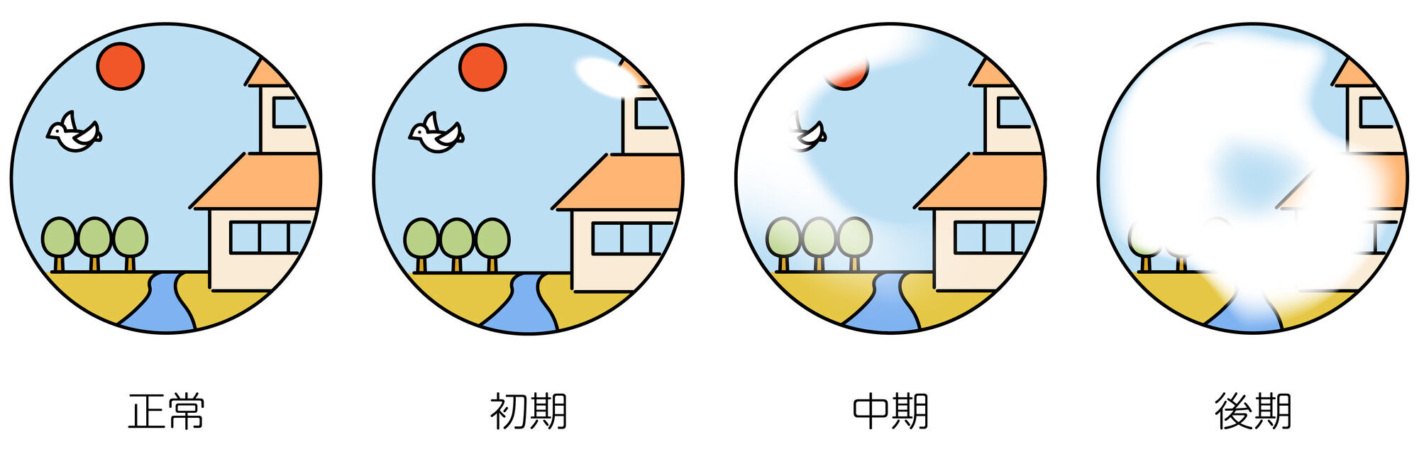 緑内障 視野変化