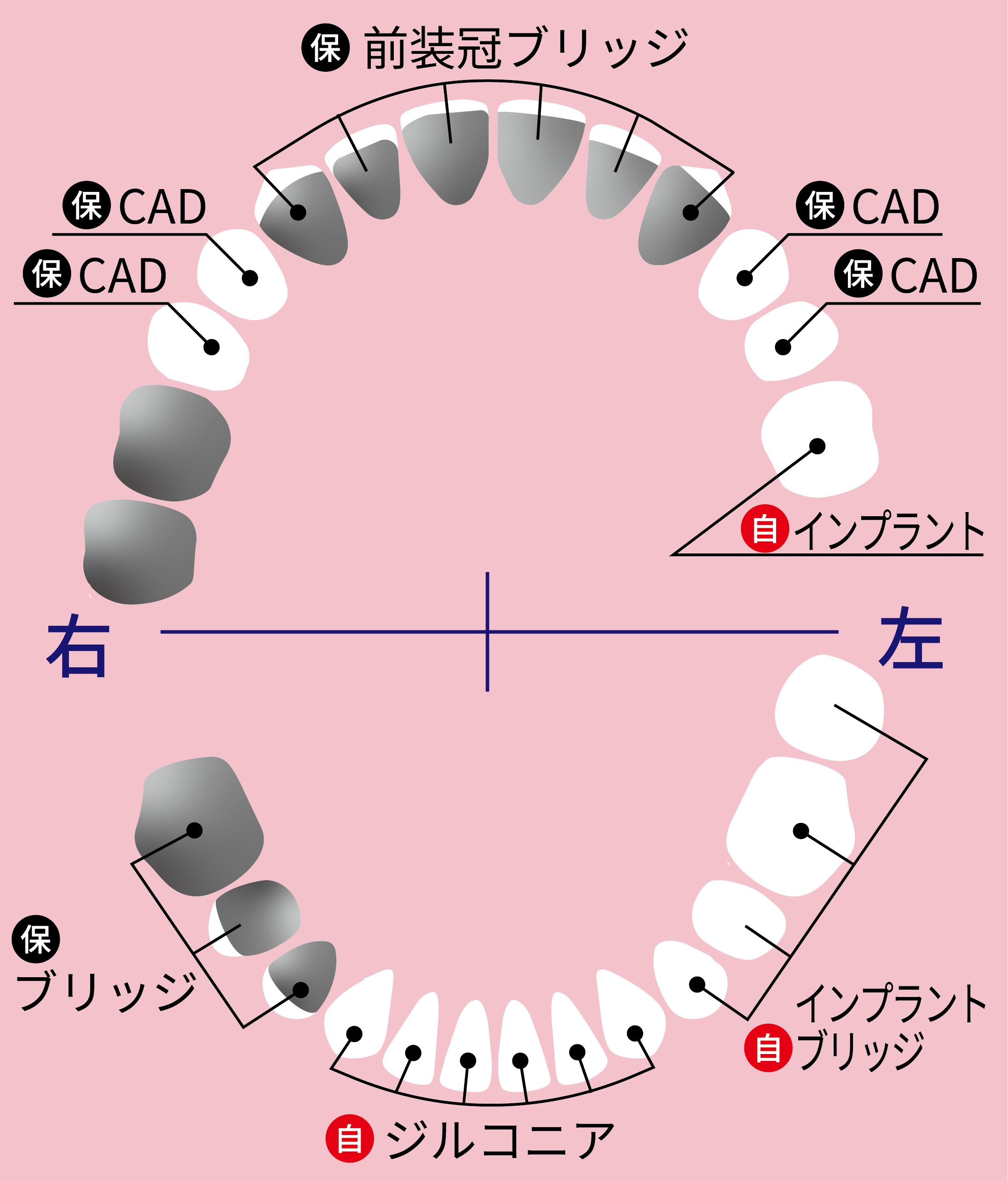 中澤さんビフォーアフターの歯図-2