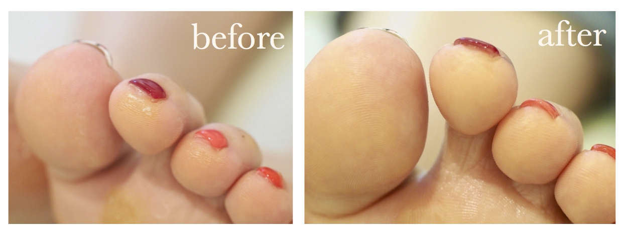 静岡で本格角質フットケア フスフレーゲならアミューネイル 静岡で本格角質フットケア フスフレーゲならアミューネイル