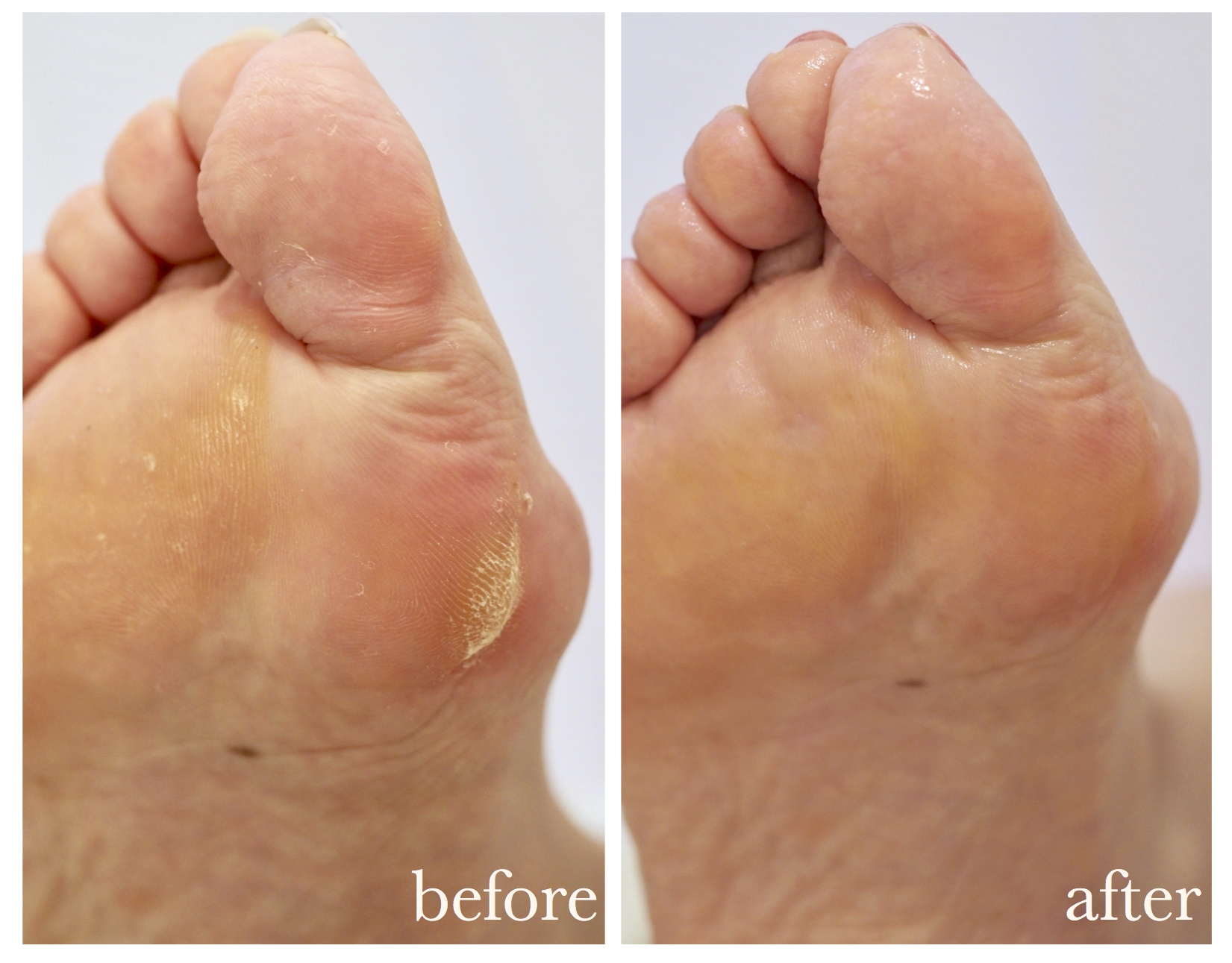 静岡で本格角質フットケア フスフレーゲならアミューネイル 静岡で本格角質フットケア フスフレーゲならアミューネイル