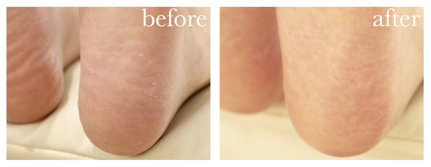 静岡で本格角質フットケア フスフレーゲならアミューネイル 静岡で本格角質フットケア フスフレーゲならアミューネイル