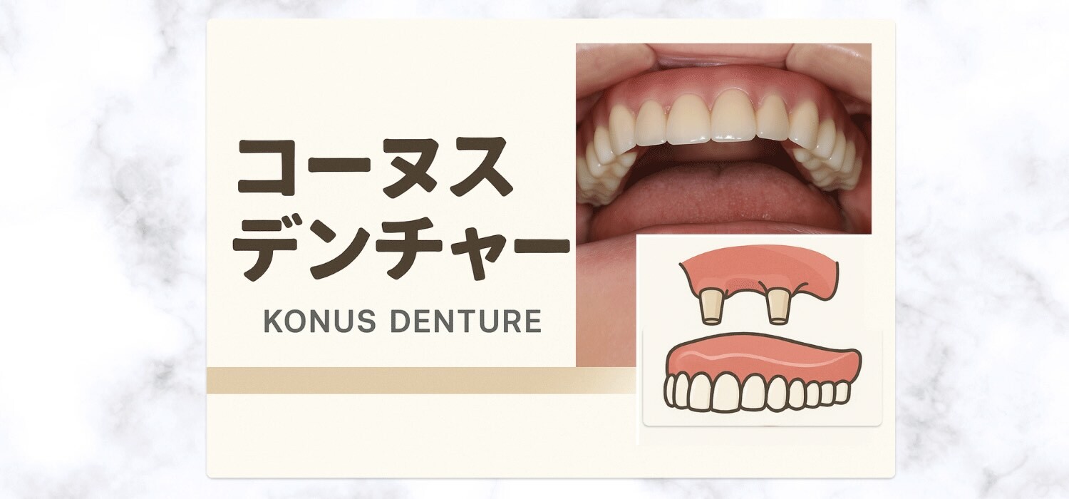 コーヌスデンチャー