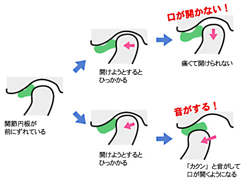 咬合治療 宮城県大崎市古川の三塚歯科クリニック
