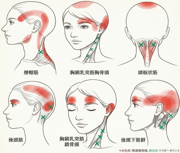 頭痛や目の奥の痛みに関係する筋肉とトリガーポイント