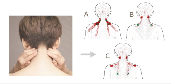 症状と原因となる筋肉の関係を示したイメージ